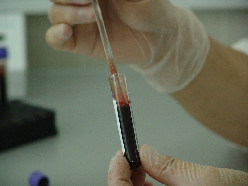 혈액검사를 통해 모든 암을 조기진단하는 기술이 미국에서 개발됐다. 픽사베이