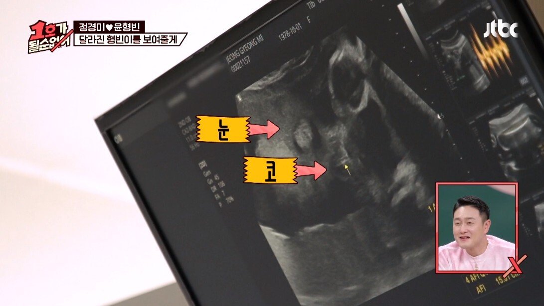 초음파 검사 중에 태아 심장 소리 듣고 울컥한 윤형빈 - 꾸르